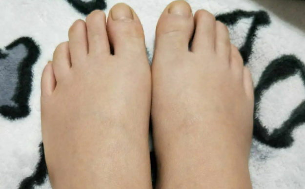 怀孕期间如何减少脚部肿胀？