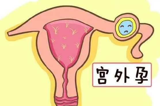 什么是宫外孕？？