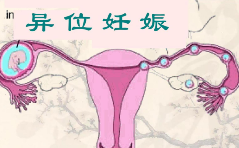 异位妊娠的体征和症状是怎样的？