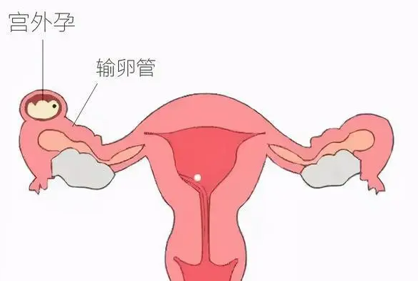 宫外孕如何治疗？