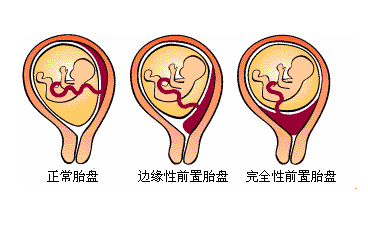 什么是前置胎盘？