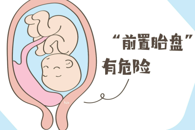 前置胎盘有哪些类型？
