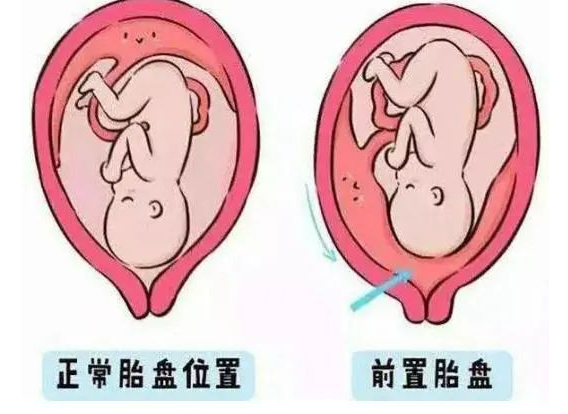 前置胎盘有哪些危险因素？
