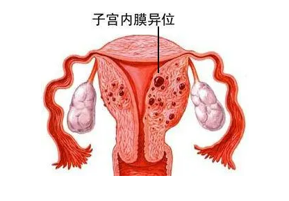什么是子宫内膜异位症和子宫腺肌症?