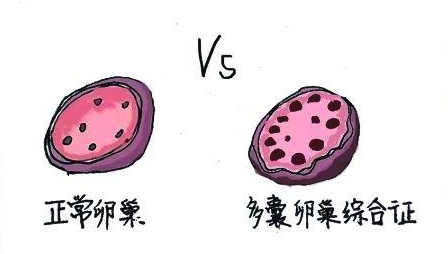 有多囊卵巢综合征(PCOS) 怎么怀孕？