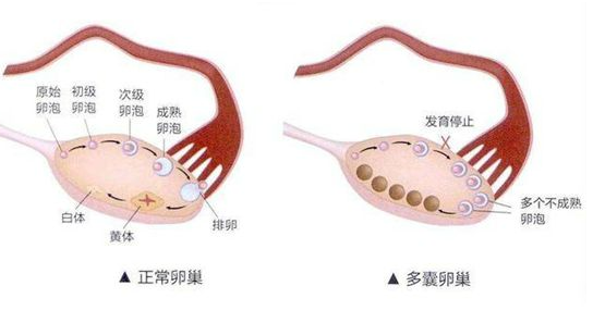 哪些药物对多囊卵巢综合征能起作用？（1）