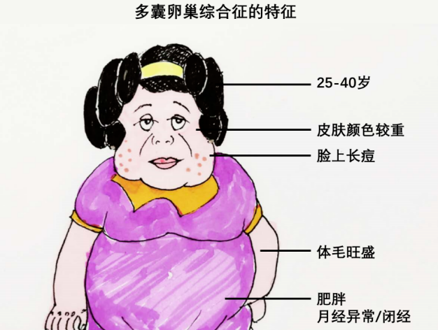 多囊卵巢综合征症状是什么样的？