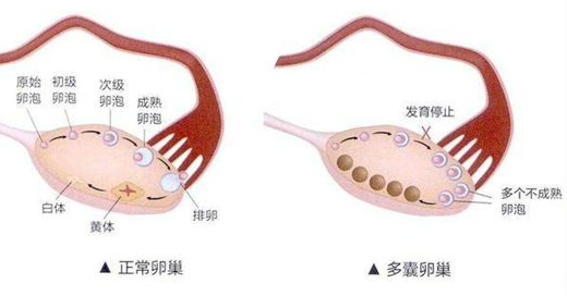 多囊卵巢综合征会有哪些并发症？