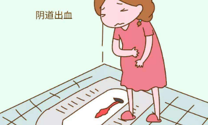 阴道流血该如何评估？