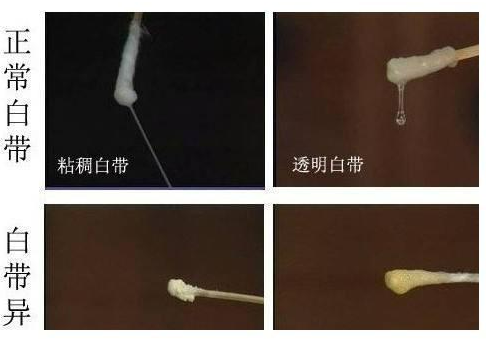 阴道分泌物的不常见病因是什么？