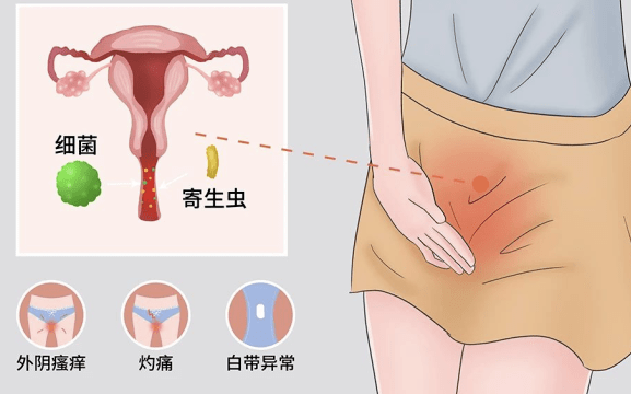 中老年女性精要：阴道分泌物