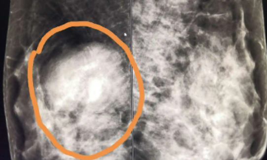 什么是乳房肿块？乳房肿块的病因是什么？