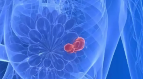 什么是乳腺纤维腺瘤？