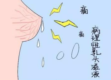 乳头溢液应该怎样评估？