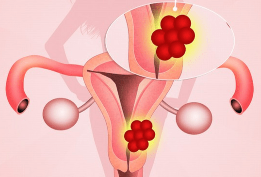 女性生殖系统癌症如何治疗？