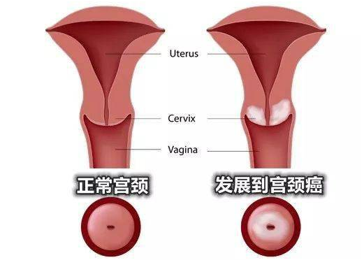 宫颈癌如何治疗？
