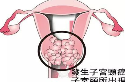 阴道癌如何分期？