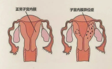 究竟什么是子宫内膜异位症？