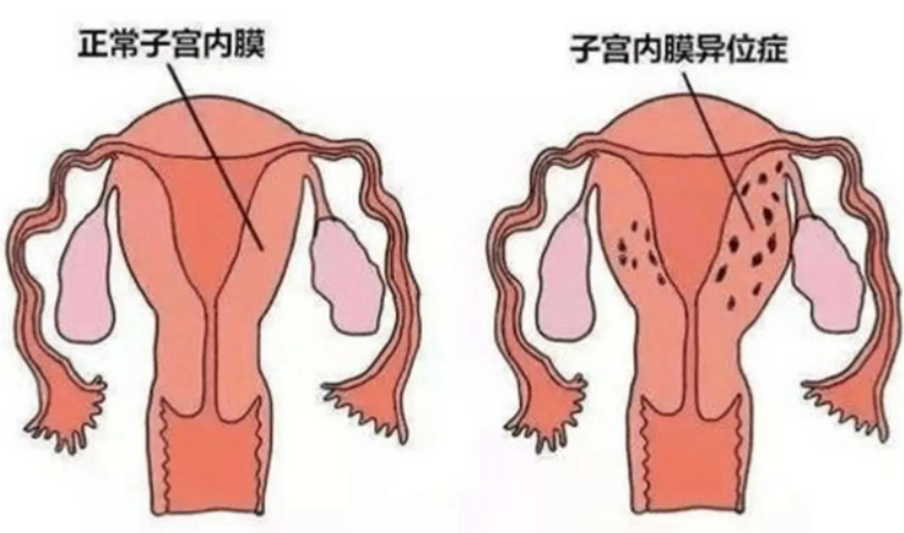 子宫内膜异位症的症状有哪些？