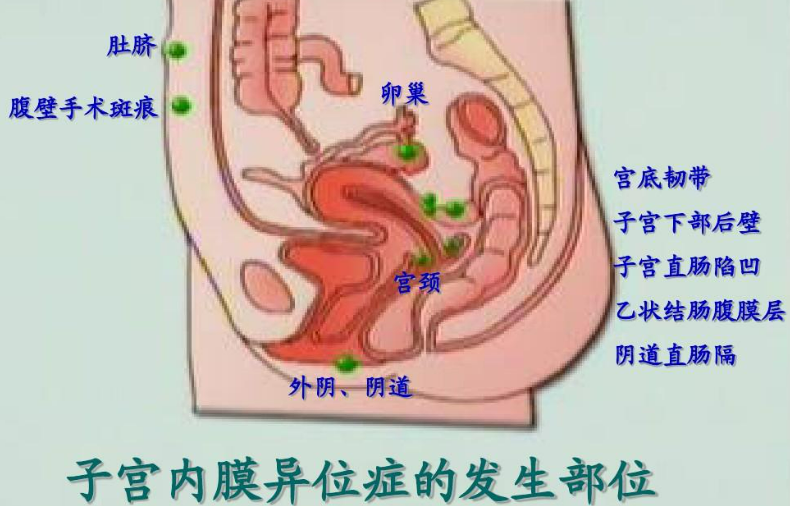 治疗子宫内膜异位症的药物有哪些？