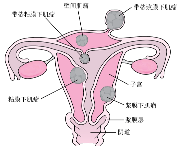 请问什么是子宫肌瘤？