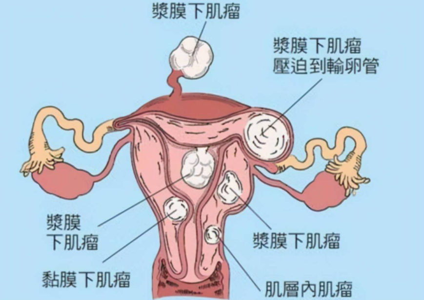 子宫肌瘤的症状是什么？