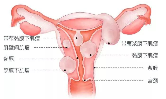 子宫肌瘤要如何治疗？