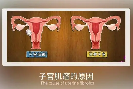 子宫肌瘤还有哪些其他治疗方法？