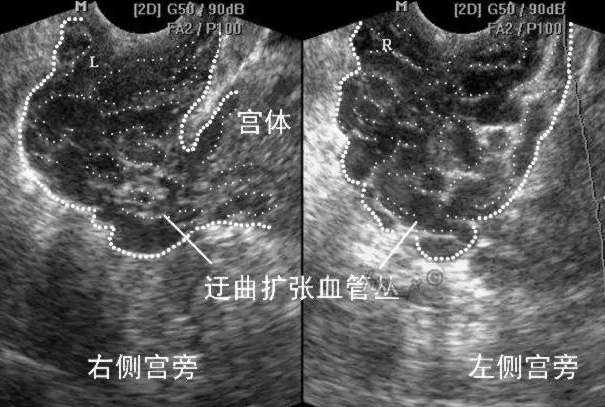 什么是盆腔淤血综合征？