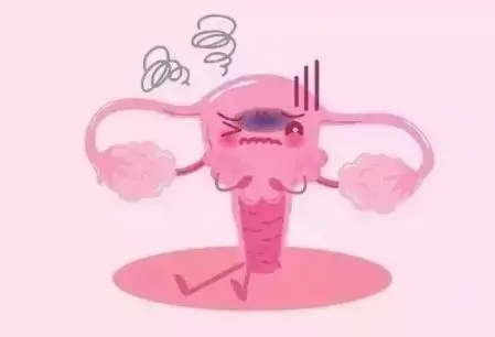 盆腔淤血综合征该怎么治疗？