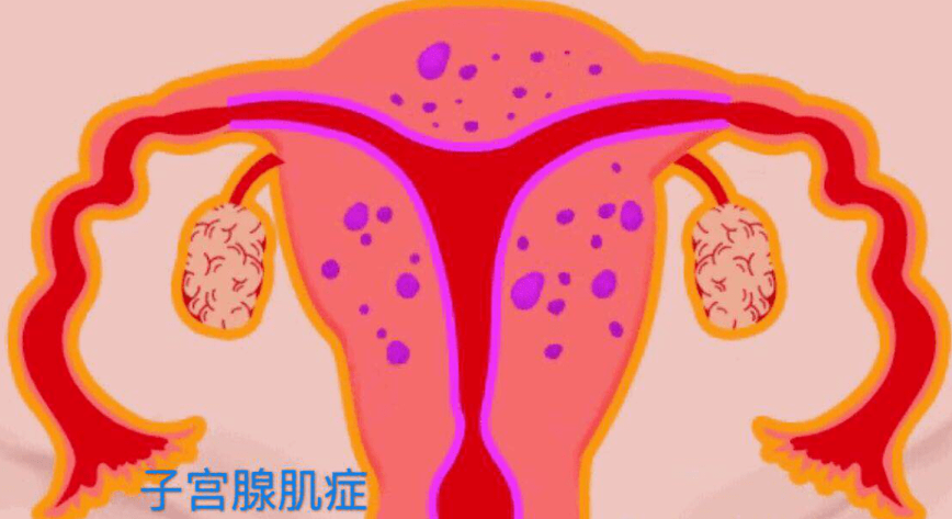 什么是子宫腺肌病？