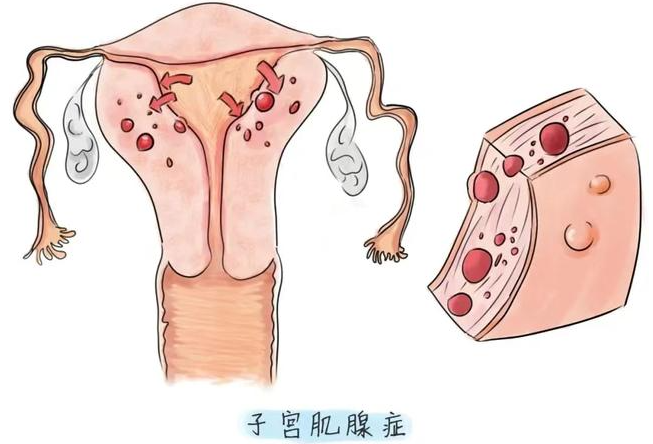 子宫腺肌病如何诊断？
