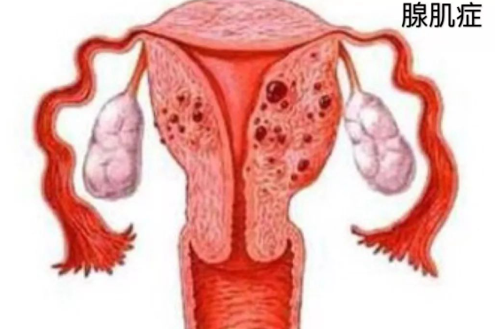 子宫腺肌病如何治疗？