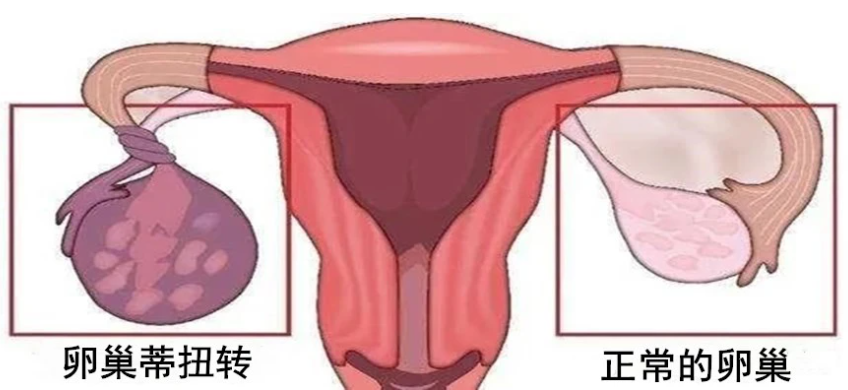 附件扭转要如何治疗？