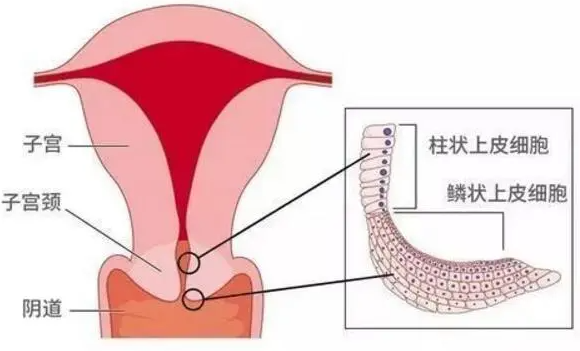 什么是宫颈狭窄？