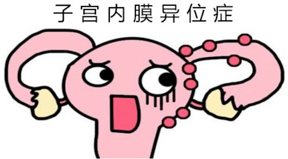 什么是外阴子宫内膜异位囊肿？