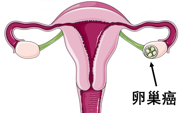 非癌性的卵巢肿块有什么症状？