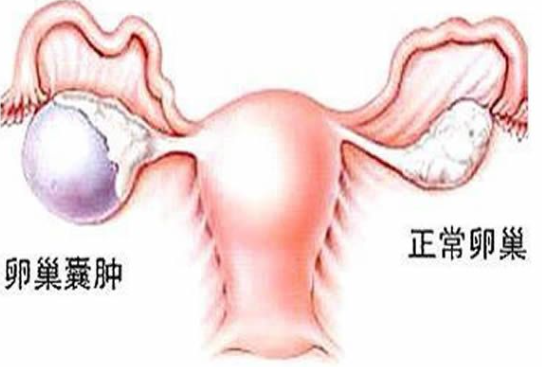 非癌性的卵巢肿块如何治疗？