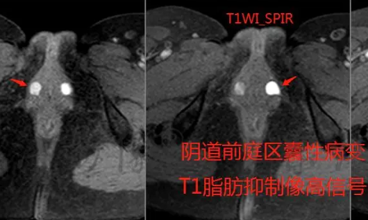 Skene氏管囊肿如何诊断和治疗？