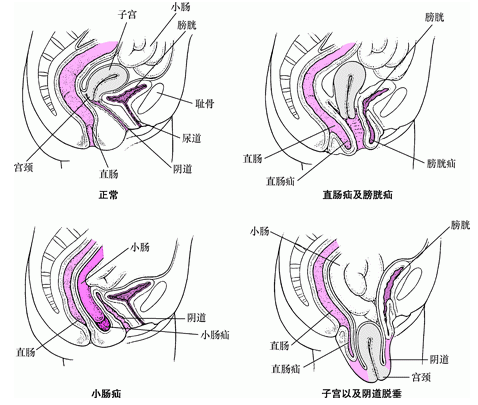 盆腔器官脱垂的病因是什么？