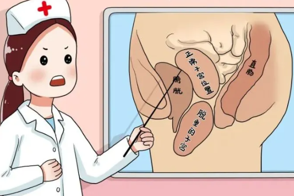 盆腔器官脱垂如何分类，都有哪些症状？