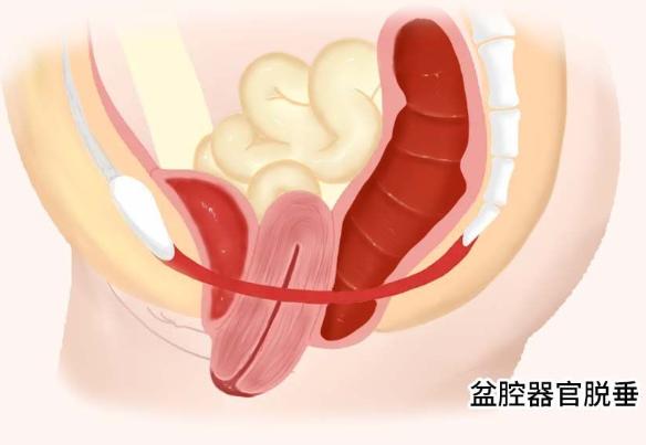 盆腔器官脱垂如何诊断？