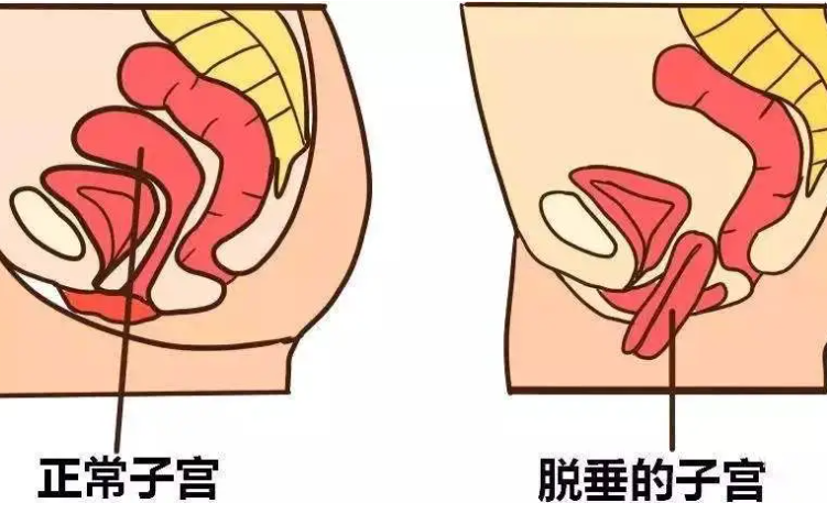 盆腔器官脱垂如何治疗？