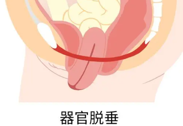 盆腔器官脱垂如何手术治疗？