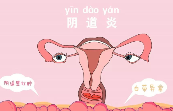 什么是阴道炎？