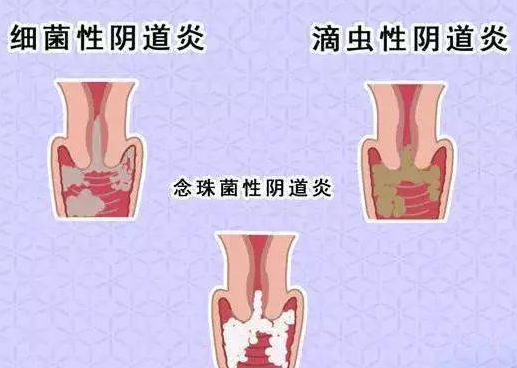 细菌性阴道病如何诊断？