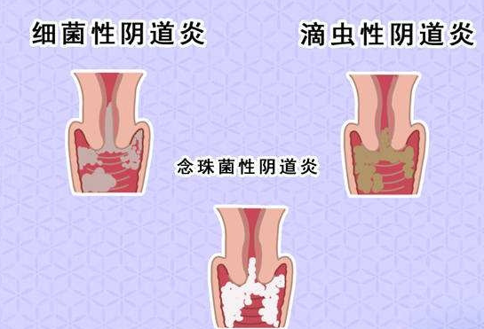 滴虫性阴道炎如何诊断？
