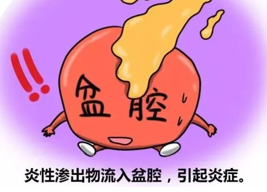 盆腔炎如何治疗？