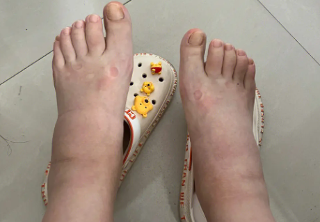 什么是孕晚期水肿？
