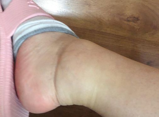 孕晚期水肿的病因是什么？
